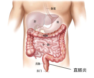 直肠炎部位.jpg