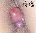 痔疮3.jpg