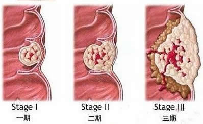 结肠癌.jpg