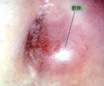 肛周脓肿.jpg