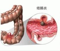 结肠炎.jpg