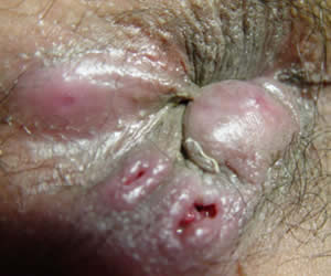 （A1)视诊，丰益肛肠医院患者，女,22,确诊肛瘘.jpg