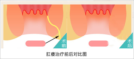 肛瘘手术前后对比.jpg