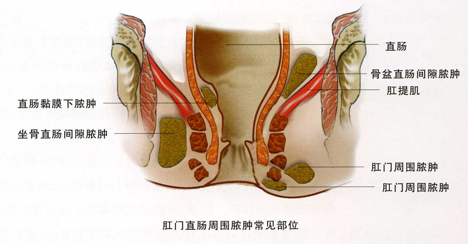 肛周脓肿的6个症状.jpg