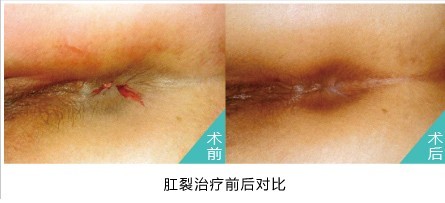 肛裂手术前后.jpg