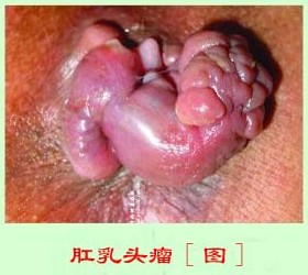 肛乳头瘤.jpg