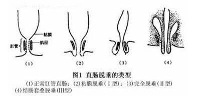 脱肛的类型.jpg