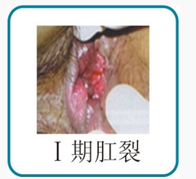 I期肛裂.jpg