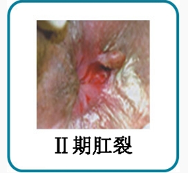 II期肛裂.jpg
