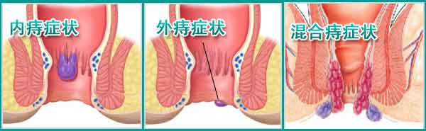三种痔疮.jpg