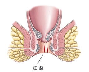 肛裂1.jpg