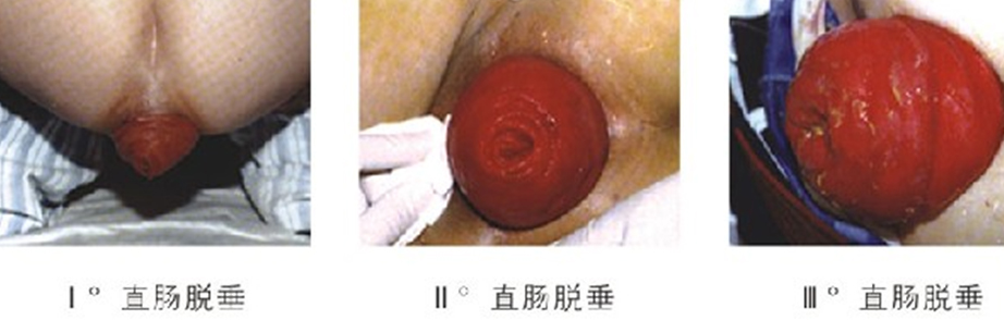 脱肛的症状.jpg