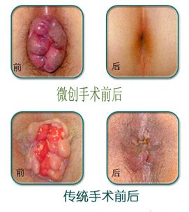 传统手术与PPH手术前后对比图.jpg