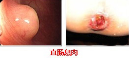直肠息肉.jpg