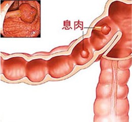 肠息肉.jpg