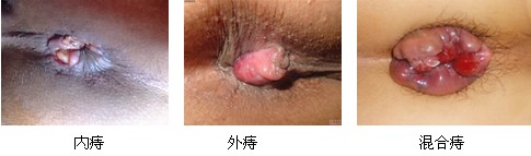 痔疮图.jpg