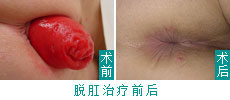 脱肛的治疗效果0.jpg
