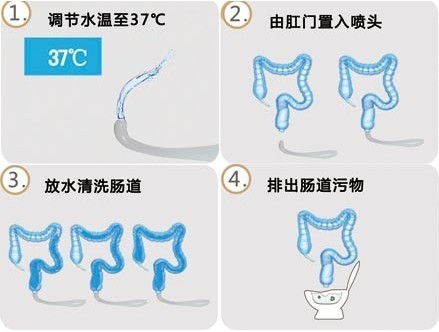 大肠水疗过程.jpg