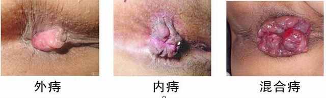 三痔.jpg