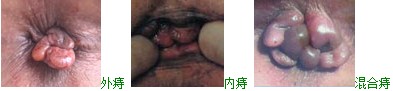 内痔.gif