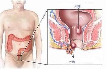 痔疮.jpg