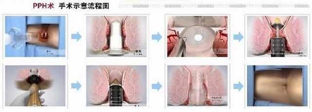 PPH治疗流程.jpg