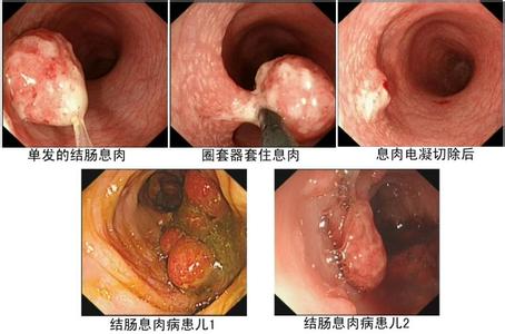 直肠息肉1.jpg