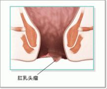 肛乳头肥大1.jpg