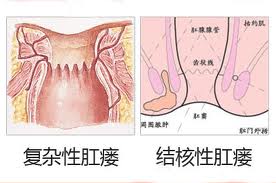肛瘘.jpg