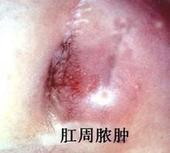 肛周脓肿.jpg