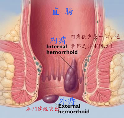 痔疮1.jpg