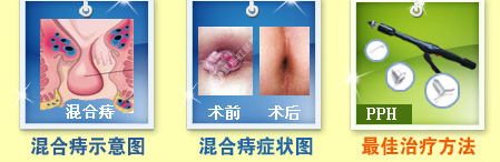混合痔疮12.gif