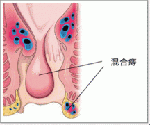 混合痔疮.gif