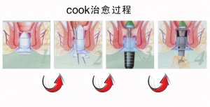 cook治疗过程.jpg