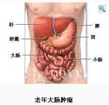 老年人大肠肿瘤.jpg
