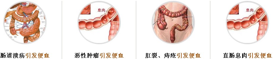 便血五大症状引起.jpg