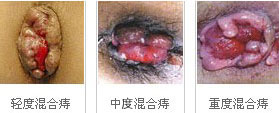 混合痔.jpg