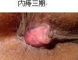 内痔3期.jpg