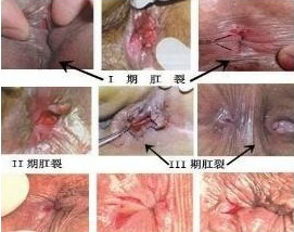 肛裂4.jpg
