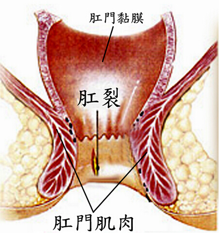 。肛裂.jpg