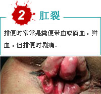 便血疾病图2.jpg