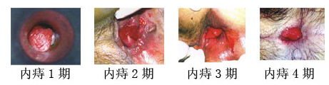 内痔的4个分期.jpg
