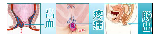痔疮早中晚期图片.jpg