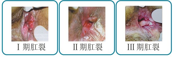 肛裂.jpg
