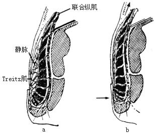 肛瘘