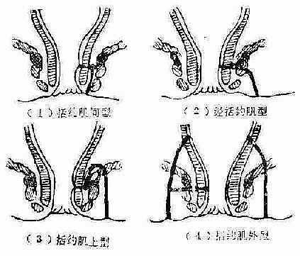 直肠脱垂