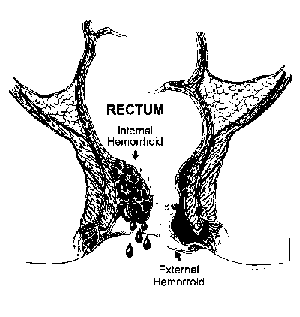 便血