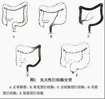 先天性巨结肠