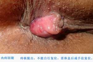 内痔