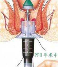 PPH治疗内痔